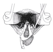 Ablation de la fissure